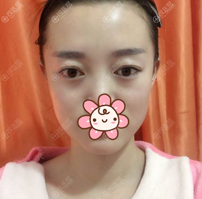 新疆乌市黎美整形许黎说我上眼睑脂肪厚,所以做了切开双眼皮
