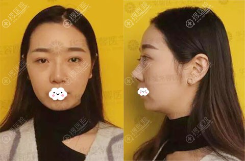 四川华美紫馨欧阳春给员工假体隆鼻换自体肋软骨鼻修复案例过程