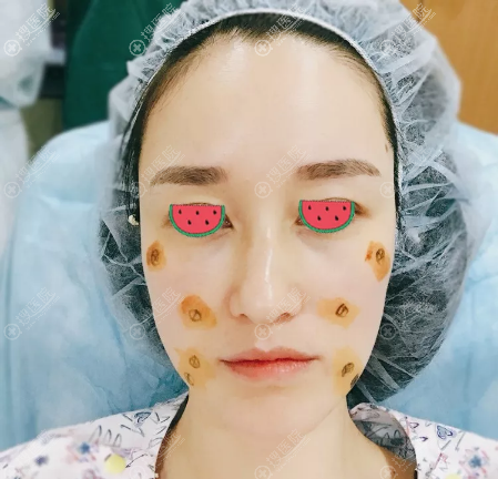 看朋友去济南伊美尔做面部埋线提升效果不错 我也心动去做了