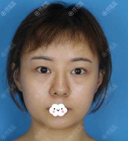 成都奕后内切去眼袋真人案例 成都奕后内切去眼袋真人案例