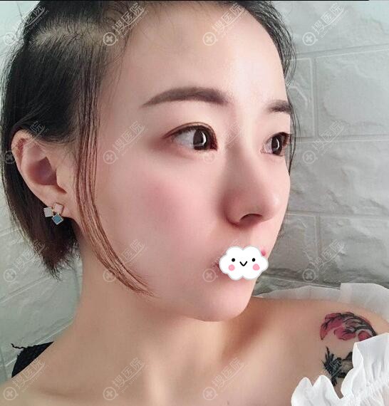成都去眼袋多少钱?成都奕做内切去眼袋4800元 成都去眼袋多少钱?成都奕做内切去眼袋4800元