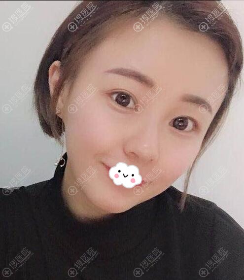 成都去眼袋哪家好?成都奕后内切去眼袋案例效果图 成都去眼袋哪家好?成都奕后内切去眼袋案例效果图