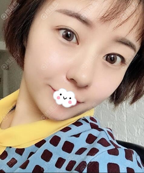 成都奕后内切去眼袋效果怎么样? 成都奕后内切去眼袋效果怎么样?