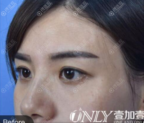 曝光合肥壹加壹眼部修复细节,甘泉涌双眼皮+开眼角恢复效果图