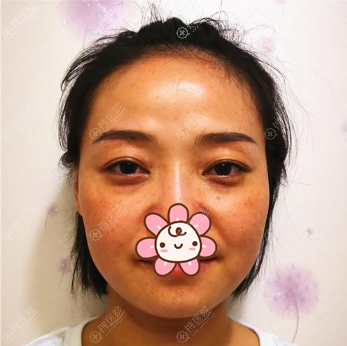 在成都星美宝岛作为面部埋线提升的她,前后差别令人惊掉下巴