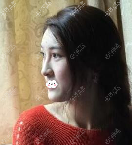 专程飞去广州韩妃找刘志刚做鼻子硅胶假体取出后隆鼻综合整形