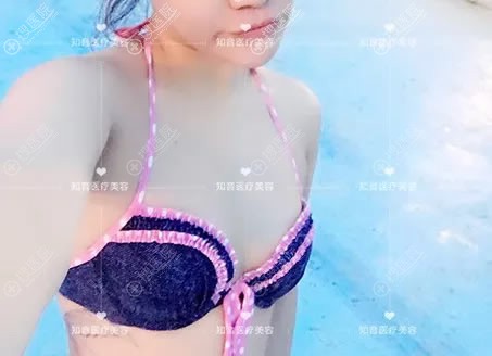 成年后胸部一直是A罩杯,这次北京知音李奇军用假体隆胸升C杯了