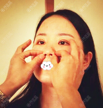 佛山曙光金子何宜新双眼皮隆鼻整形怎么样 佛山曙光金子何宜新双眼皮隆鼻整形怎么样