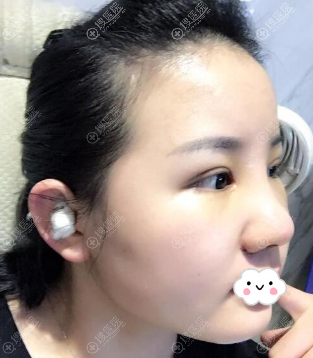 佛山曙光金子何宜新隆鼻术后4天案例图 佛山曙光金子何宜新隆鼻术后4天案例图