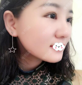 佛山双眼皮隆鼻哪家好?佛山曙光金子何宜新案例 佛山双眼皮隆鼻哪家好?佛山曙光金子何宜新案例