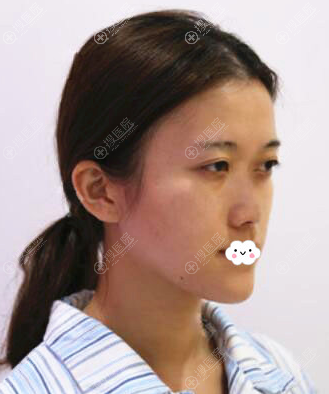 打听东莞君熠刘伟杰修复手术做的好,找他做鼻综合隆鼻整形案例