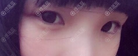 这就是找无锡江阴东方整形医院闫家峰做6mm双眼皮1个月恢复效果