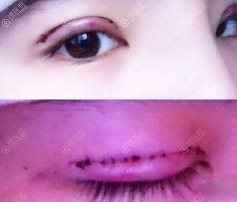 刚做完双眼皮睁眼和闭眼的效果 刚做完双眼皮睁眼和闭眼的效果