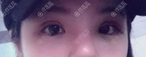 做完双眼皮3天恢复效果图 做完双眼皮3天恢复效果图
