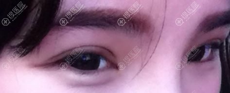 <!--<i data=20240710 data-id=13586></i>-->医院双眼皮案例15天效果 <!--<i data=20240710 data-id=13586></i>-->医院双眼皮案例15天效果