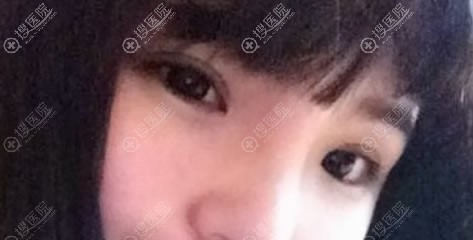 <!--<i data=20240710 data-id=13586></i>-->医院闫家峰双眼皮案例 <!--<i data=20240710 data-id=13586></i>-->医院闫家峰双眼皮案例