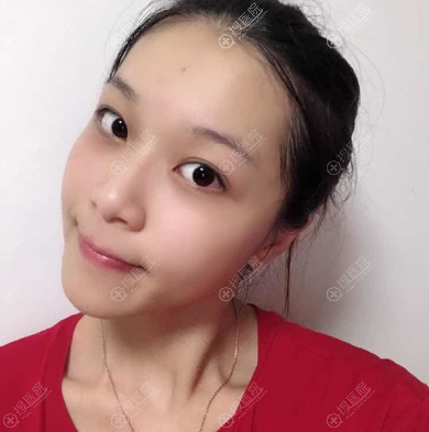 面部线雕提升一周后的图片 面部线雕提升一周后的图片