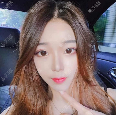 苏州康美整形医院面部线雕真人案例 苏州康美整形医院面部线雕真人案例