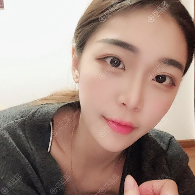 苏州康美面部线雕案例一个月恢复过程 苏州康美面部线雕案例一个月恢复过程