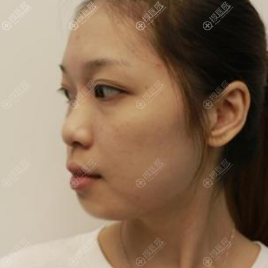 公开我在苏州康美做面部线雕提升的经历以及一周后的对比照片
