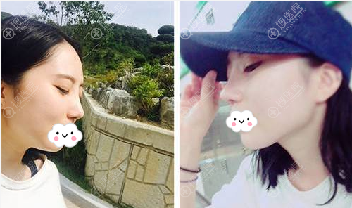 太原华美肋软骨综合隆鼻术后7天 太原华美肋软骨综合隆鼻术后7天