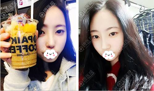 自体软骨隆鼻术后一个月恢复照 自体软骨隆鼻术后一个月恢复照