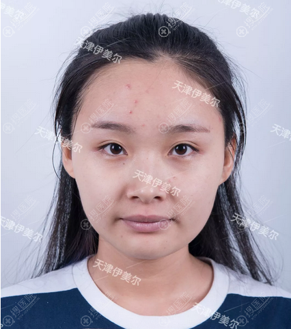 看了天津伊美尔于广洋杨文国的案例后找卫星主任做了双眼皮隆鼻