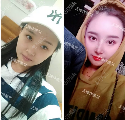 <!--<i data=20240710 data-id=12673></i>-->卫星做的双眼皮隆鼻案例对比图 <!--<i data=20240710 data-id=12673></i>-->卫星做的双眼皮隆鼻案例对比图