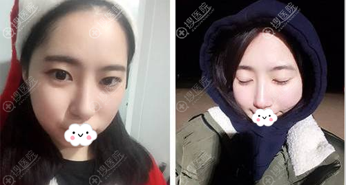 肋软骨鼻综合术后5个月照片 肋软骨鼻综合术后5个月照片