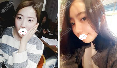 太原华美肋软骨综合隆鼻术后对比照片 太原华美肋软骨综合隆鼻术后对比照片
