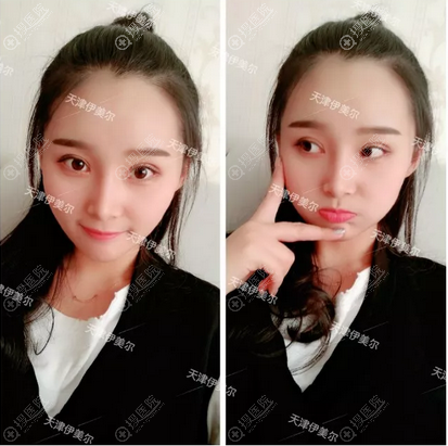 <!--<i data=20240710 data-id=12673></i>-->卫星主任做的双眼皮案例 <!--<i data=20240710 data-id=12673></i>-->卫星主任做的双眼皮案例