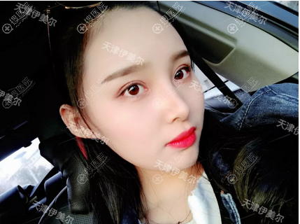<!--<i data=20240710 data-id=12673></i>-->双眼皮隆鼻术后自拍 <!--<i data=20240710 data-id=12673></i>-->双眼皮隆鼻术后自拍