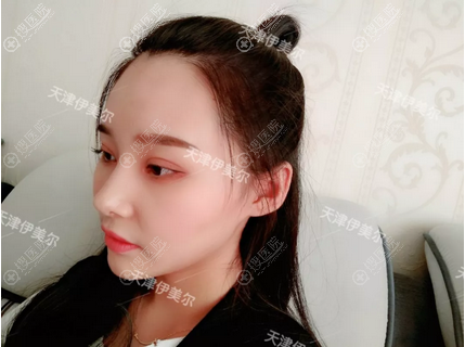 <!--<i data=20240710 data-id=12673></i>-->卫星做的隆鼻案例 <!--<i data=20240710 data-id=12673></i>-->卫星做的隆鼻案例