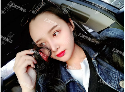 <!--<i data=20240710 data-id=12673></i>-->双眼皮隆鼻案例 <!--<i data=20240710 data-id=12673></i>-->双眼皮隆鼻案例