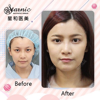 上海星和医美吴捷能医生做的双眼皮案例 上海星和医美吴捷能医生做的双眼皮案例