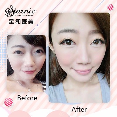 上海星和医美自体脂肪面部填充案例 上海星和医美自体脂肪面部填充案例
