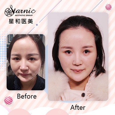 上海星和医美面部线雕埋线提升案例 上海星和医美面部线雕埋线提升案例