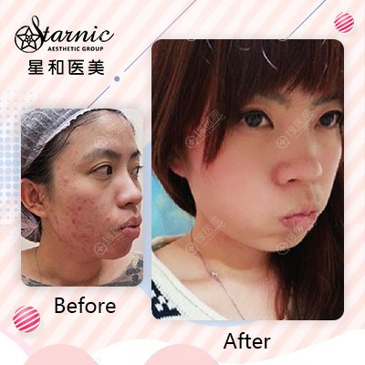 上海星和医美全脸蜂巢皮秒祛斑案例 上海星和医美全脸蜂巢皮秒祛斑案例