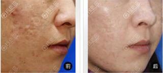 宜春华美痘坑修复真人案例 宜春华美痘坑修复真人案例