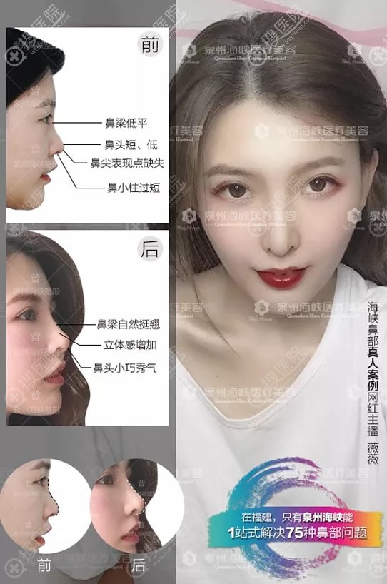 泉州海峡高挺小翘鼻真人案例 泉州海峡高挺小翘鼻真人案例