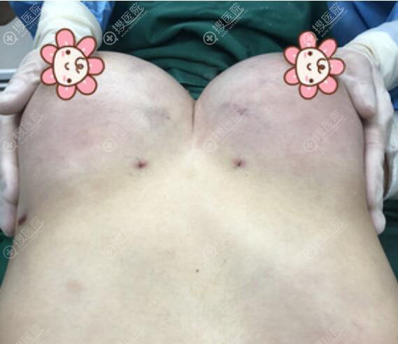 在<!--<i data=20240710 data-id=11953></i>-->医疗美容找费博文韬做自体脂肪隆胸术后效果 在<!--<i data=20240710 data-id=11953></i>-->医疗美容找费博文韬做自体脂肪隆胸术后效果