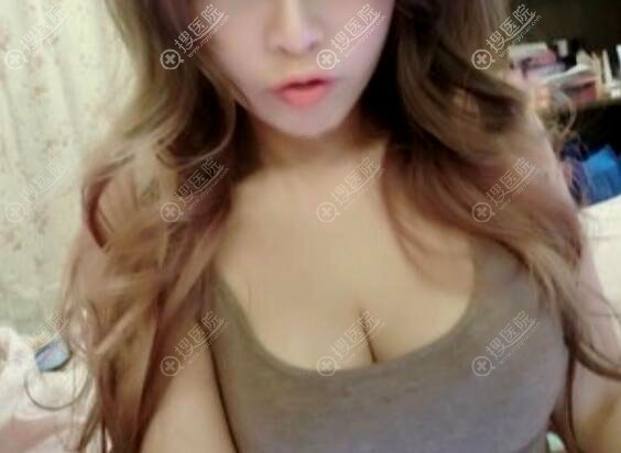惠州隆胸哪家好?费博文韬自体脂肪丰胸术后恢复效果 惠州隆胸哪家好?费博文韬自体脂肪丰胸术后恢复效果