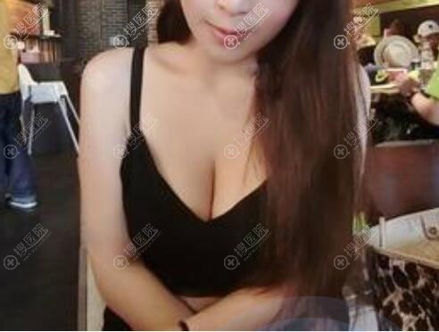 排斥假体在惠州做自体脂肪案例 排斥假体在惠州做自体脂肪案例