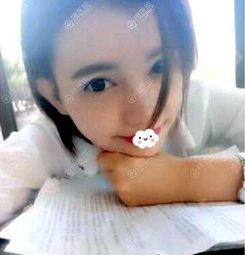 惠州惠阳丽港注射瘦脸除皱术后1月效果 惠州惠阳丽港注射瘦脸除皱术后1月效果