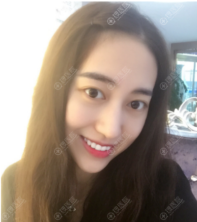 上海逆时针医疗美容祛眼袋术后照片 上海逆时针医疗美容祛眼袋术后照片