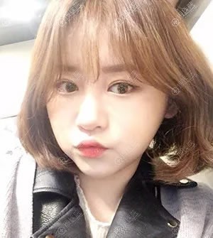 韩国原辰面部轮廓(颧骨+下颌角+下巴)缩小术助我成功摆脱大圆脸