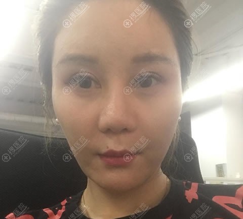 重庆郑荃丽格做隆鼻怎么样?这是我做线雕隆鼻100天的效果图