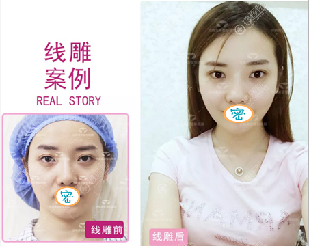 小编采访四个不同年龄女性在济南美容整形医院做线雕的真实感受