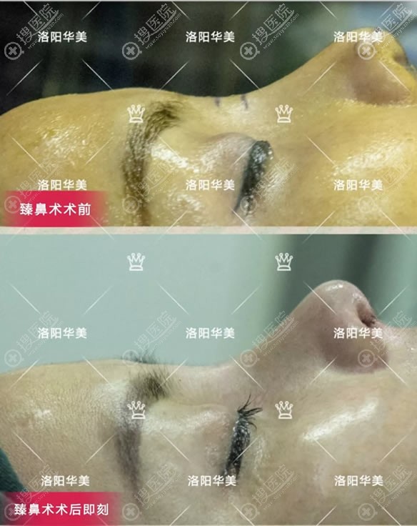 洛阳华美王锦文自体软骨鼻综合案例即刻效果图 洛阳华美王锦文自体软骨鼻综合案例即刻效果图