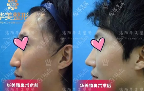 洛阳华美宋俊岭驼峰鼻综合矫正案例 洛阳华美宋俊岭驼峰鼻综合矫正案例
